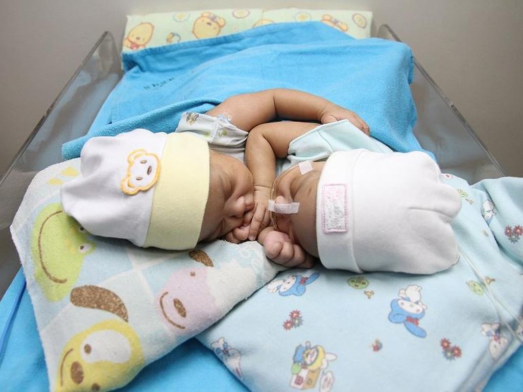 Berhasil Dipisahkan, Kondisi Bayi Kembar Siam Gisya-Gesya Masih Kritis