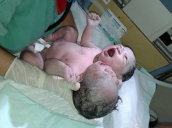 Bayi Berkepala Dua di Makassar Meninggal Dunia di Usia 3 Hari