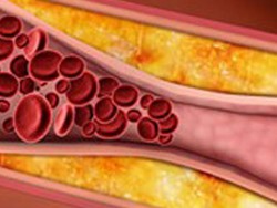 Ini solusi Turunkan Kolesterol dalam 1 Jam !