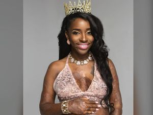 Foto-foto Inspiratif Ibu Hamil yang Pernah Alami Luka Bakar Parah