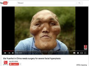 Kisah Pria yang Kepalanya Membesar Hingga 2 Kali dari Ukuran Normal