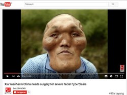 Kisah Pria yang Kepalanya Membesar Hingga 2 Kali dari Ukuran Normal