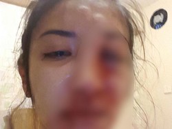 Berdarah-darah, Begini Kondisi Cewek Cantik yang Dihajar Kekasihnya