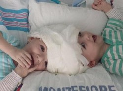 Lahir Dempet Kepala, Jadon-Anias Sukses Dipisah dengan Prosedur Langka