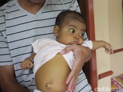 Kisah Pasutri asal Sidoarjo yang Memiliki Putri Menderita Atresia Billier