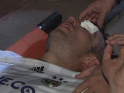 Cedera Mengerikan Van Persie: Kelopak Mata Terkoyak