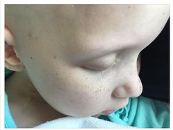 Menyentuh! Foto Bocah yang Bulu Matanya Tinggal 1 Helai Akibat Efek Kemoterapi