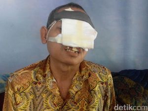Pria Paruh Baya Ini Rawat Sendiri Wajahnya yang Nyaris Habis karena Kanker