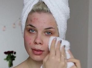 Wajah Berjerawat, Vlogger Kecantikan Ini Di-Bully Mirip Lumut Hingga Badut