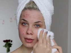 Wajah Berjerawat, Vlogger Kecantikan Ini Di-Bully Mirip Lumut Hingga Badut