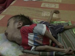 Kisah Rizki, Anak Umur 8 Tahun yang Lumpuh Total Karena Hidrosefalus