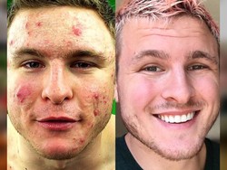 Pernah Berjerawat Parah, Pria Ini Ungkap Tips yang Buat Wajahnya Kembali Mulus