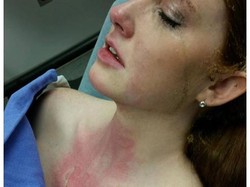 Foto Dada Wanita Terluka Bakar Viral di Instagram