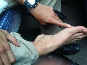 Kaki Kapalan? Kenali 3 Penyebabnya Lebih Dulu