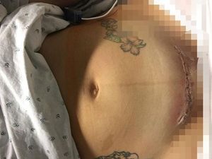 Cerita di Balik Foto Luka Caesar Seorang Ibu yang Jadi Viral