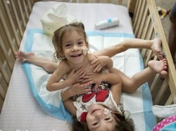 Jalani Operasi 18 Jam, Bocah Kembar Siam Ini Akhirnya Dipisahkan