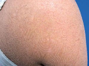 Kena Infeksi Fungi Tak Biasa, Ruam Berpola Muncul di Tubuh Wanita Ini