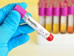 Anak Mudah Memar Saat Terbentur? Waspadai Hemofilia