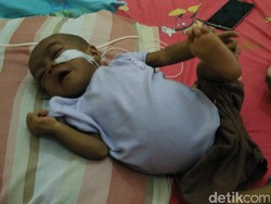Kisah Naura, Balita Pengidap Atresia Bilier Sekaligus Gizi Buruk