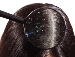 Ini Cara Menghilangkan Ketombe dengan Cepat dan Mudah