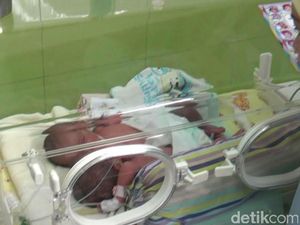 Kembar Siam Dempet Perut asal Probolinggo Tak Punya Anus