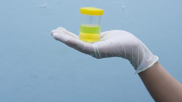 Waspadai Jika Urine Seperti Ini, Bisa Jadi Tanda Sakit Ginjal-Infeksi Waspadai Jika Urine Seperti Ini, Bisa Jadi Tanda Sakit Ginjal-Infeksi