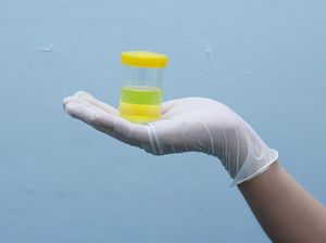 Dokter Wanti-wanti Warna Urine Seperti Ini Berisiko Picu Batu Ginjal Dokter Wanti-wanti Warna Urine Seperti Ini Berisiko Picu Batu Ginjal