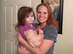 Lengan Balita Ini Jadi Sebesar Semangka karena Kondisi Langka