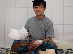 Operasi Sukses, Manusia Pohon Ini Dapatkan Tangannya Kembali