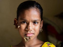 Diduga Idap Sindrom Manusia Pohon, Wajah Bocah Ini Mulai Ditumbuhi Kayu