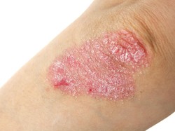 Pria Ini Idap Kondisi Langka, Kulitnya Mengeras Seperti Kulit Pohon