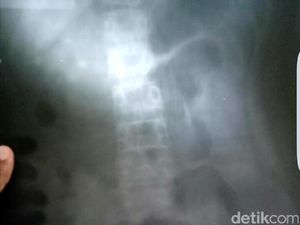 Benda-benda Ini Sering Tertelan dan Terjebak Lama di Tubuh Manusia