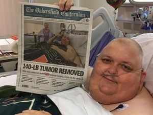 Mulanya Dikira Lemak, Benjolan 59 Kg Ini Ternyata Tumor