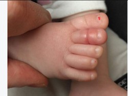 Hair Torniquet Syndrome, Saat Sehelai Rambut Hambat Aliran Darah Anak