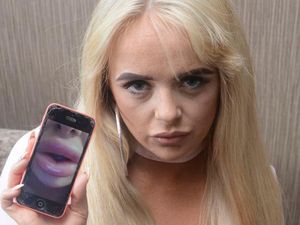 Lakukan Filler Murah, Bibir Wanita Ini Jadi Bengkak Seperti Sosis Mentah