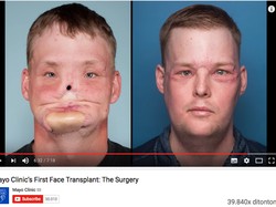 Jalani Transplantasi Wajah, Kini Andy Punya Wajah Baru