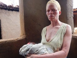 Kisah Manusia Albino yang Selamat dari Perburuan di Afrika