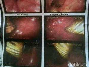 Susah BAB, Zainurrifin Coba Masukkan Pulpen Lewat Anus