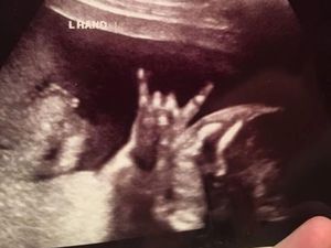 Unik! Tangan Bayi Ini Bentuk Simbol Rock N Roll Saat Di-USG