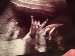 Unik! Tangan Bayi Ini Bentuk Simbol Rock N Roll Saat Di-USG