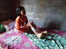 Kisah Bocah yang Kakinya Melepuh Hingga Tak Bisa Berjalan