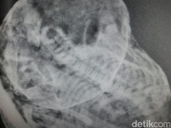 Wanita Ini 37 Tahun Mengandung Bayi yang Telah Menjadi Mumi