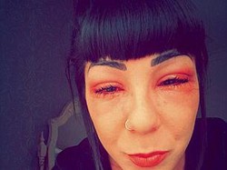 Terapi Bulu Mata Agar Lentik, Mata Wanita Ini Justru Bengkak dan Berair