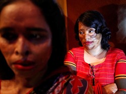 Ketika Wanita Berwajah Melepuh Korban Siraman Air Keras Jadi Model