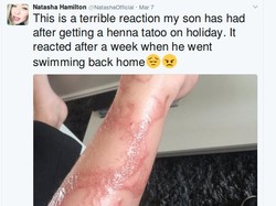 Personel Atomic Kitten Ingatkan Bahaya Tato Henna pada Anak-anak