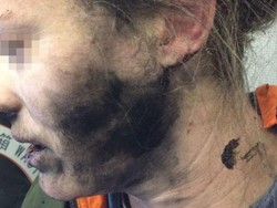 Wanita Ini Mengalami Luka Bakar Karena Headphone di Pesawat