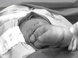 Begini Proses Kelahiran Bayi Sungsang Melalui Operasi Caesar