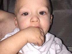 Berawal dari Foto Pakai Flash, Bayi Ini Diketahui Kena Retinoblastoma