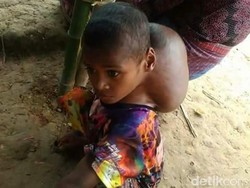 Di Leher Bocah Asal NTT Ini Ada Tumor Seukuran Kepala Orang Dewasa