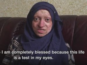 Karena Kelainan Genetik, Kulit Wanita Ini Rentan Copot dan Terluka